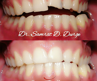 Before and after smile enhancement completed at Pune Smiles