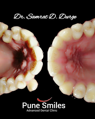 Before and after dental rehabilitation result at Pune Smiles
