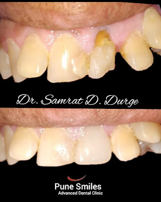 Before and after dental restoration completed at Pune Smiles