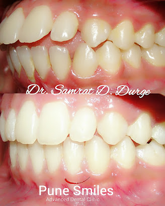 Before and after smile transformation completed at Pune Smiles