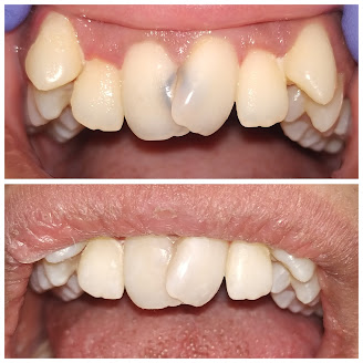 Before and after aesthetic dental treatment completed at Pune Smiles