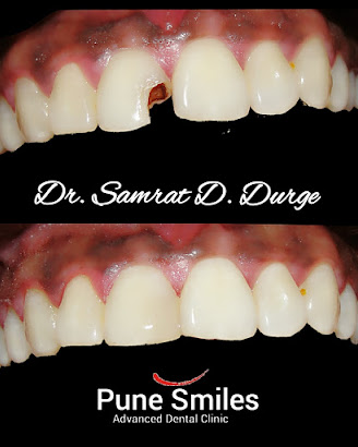 Before and after restorative dentistry result at Pune Smiles